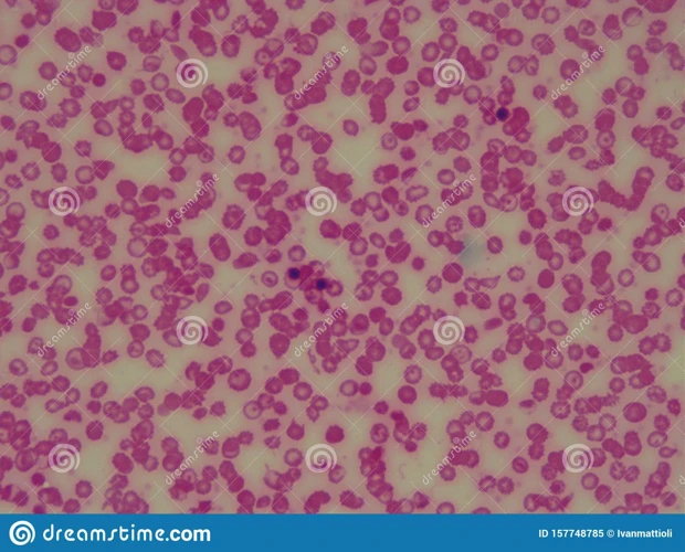 A Close Look at How Sickle Cells Anemia Appears Under a Microscope